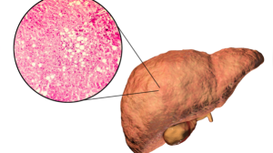 Fatty liver reversal: 5 signs the liver is healing